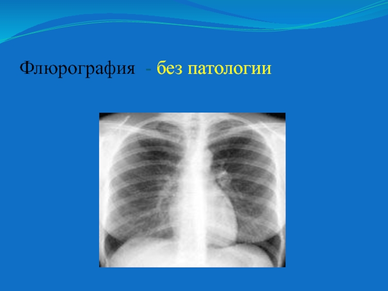 Без патологии. Легкие и сердце без патологии.