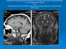19326-28-Б-Супраселлярная менингеома на нативе практически не видна(жалобы в