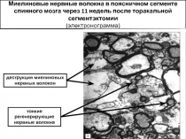 Миелиновые нервные волокна в поясничном сегменте спинного мозга через 11 недель