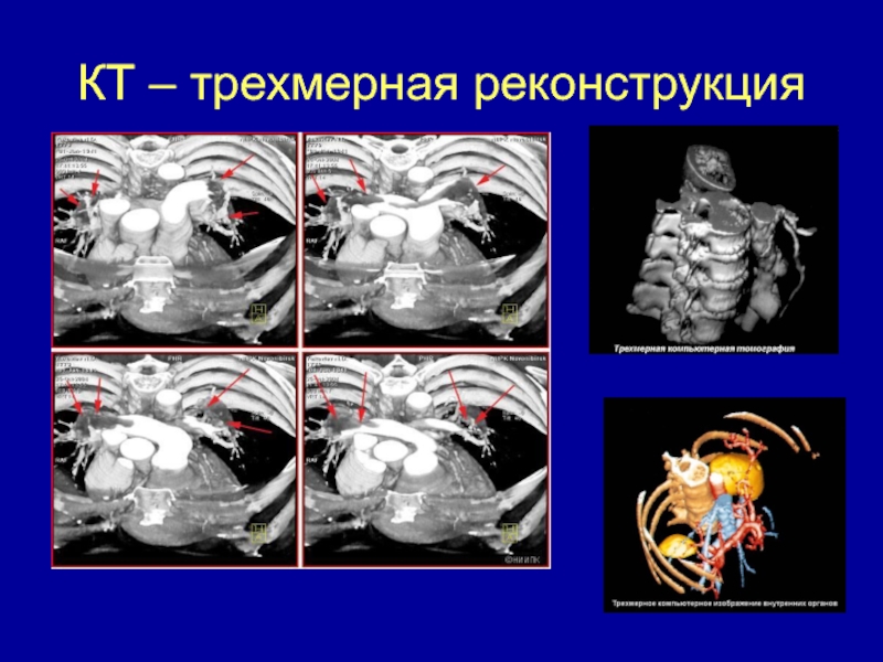 К трехмерным реконструкциям кт изображений относят