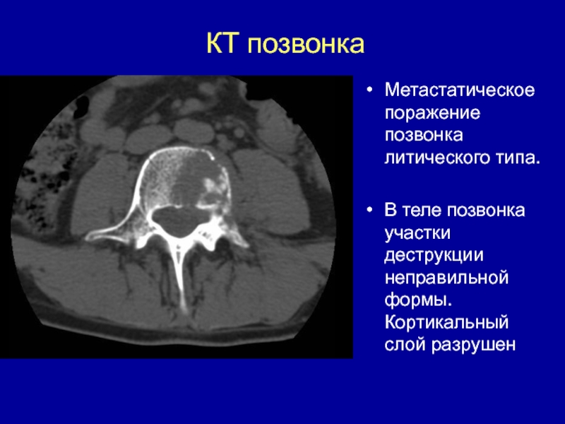 Кт картина краевой деструкции смежных костей наиболее характерна для