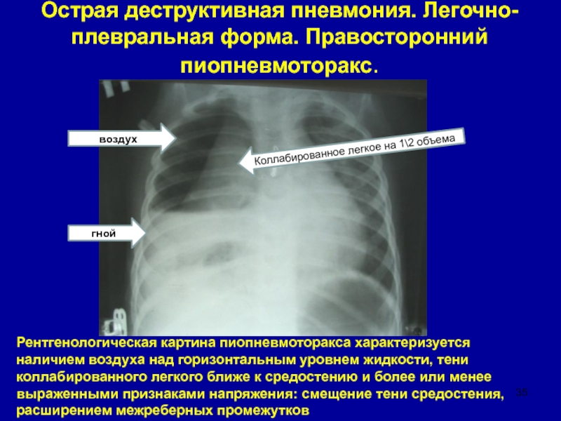 На рентгенологической картине напряженного пиопневмоторакса отмечается смещение средостения в