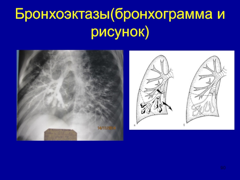 Бронхоэктазы. Локальные бронхоэктазы. Кистозный бронхоэктаз. Мешотчатые бронхоэктазы. Деструктивные бронхоэктазы.