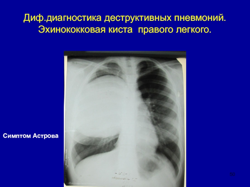 Деструктивная пневмония. Острая деструктивная пневмония. Деструктивная пневмония рентген. Деструктивная пневмония и абсцесс легкого. Диагностика деструктивной пневмонии.