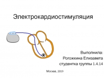 Электрокардиостимуляция