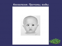 Косоглазие. Причины, виды