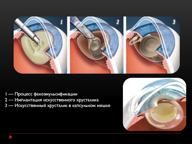 Замена хрусталика картинка