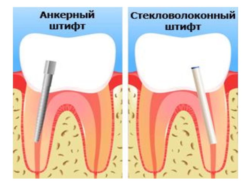 Штифт зубной картинка