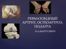 РЕВМАТОИДНЫЙ АРТРИТ, ОСТЕОАРТРОЗ, ПОДАГРА