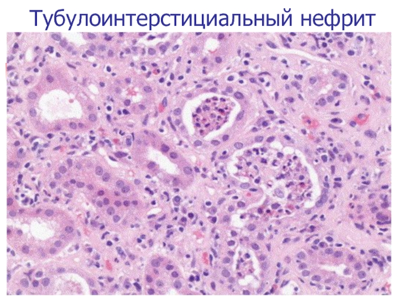 Хронический нефрит. Хронический тубулоинтерстициальный нефрит микропрепарат. Интерстициальный нефрит гистопрепарат. Тубулоинтерстициальный нефрит патанатомия. Тубулоинтерстициальный (интерстициальный) нефрит.