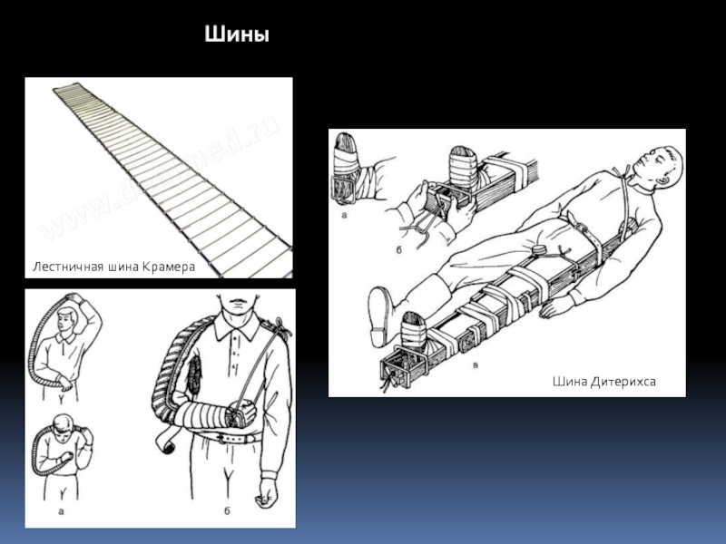 Лестничная шина для иммобилизации. Шина Дитерихса и шина Крамера. Наложение шины Дитерихса и Крамера. Стандартными шинами Крамера-Дитерихса. Шина Дитерихса строение.