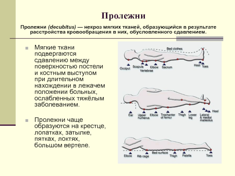 Факторы пролежней