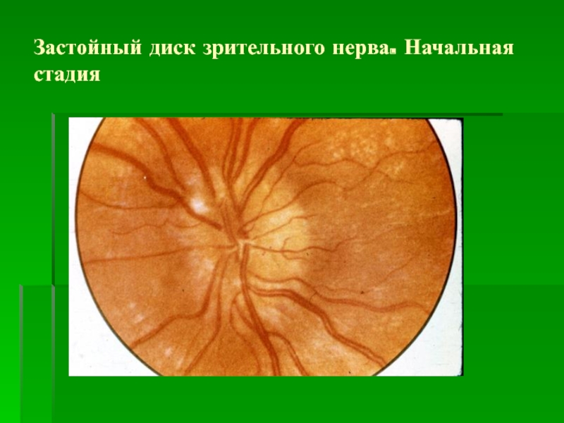 Застойный диск зрительного нерва презентация