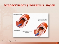 Атеросклероз у пожилых людей
Хатынская Карина 493 группа