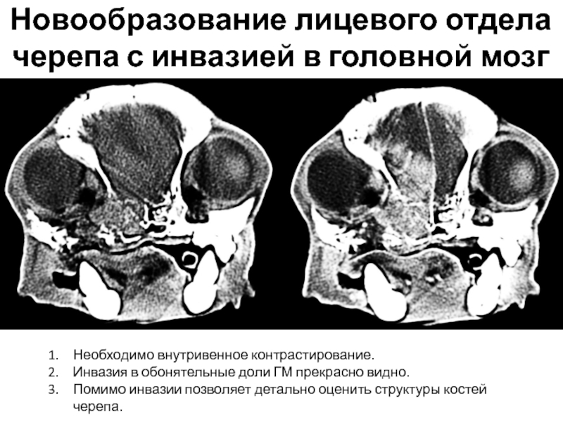 Новообразование лицевого отдела черепа с инвазией в головной мозгНеобходимо внутривенное контрастирование.Инвазия в обонятельные доли ГМ прекрасно видно.Помимо