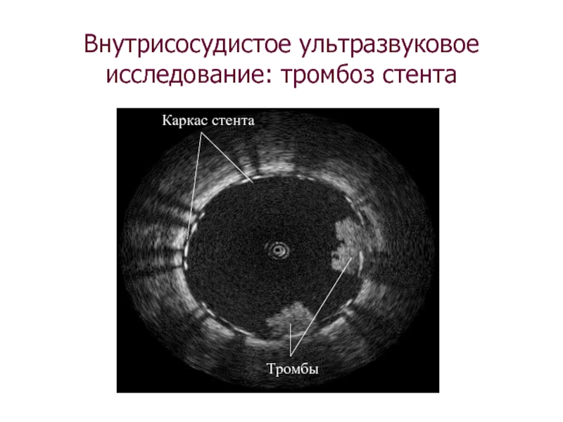 Узи коронарных артерий. Внутрикоронарное ультразвуковое исследование. Внутрисосудистое ультразвуковое исследование коронарных артерий.