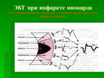 ЭКГ при инфаркте миокарда Схема морфологических изменений в сердечной мышце при