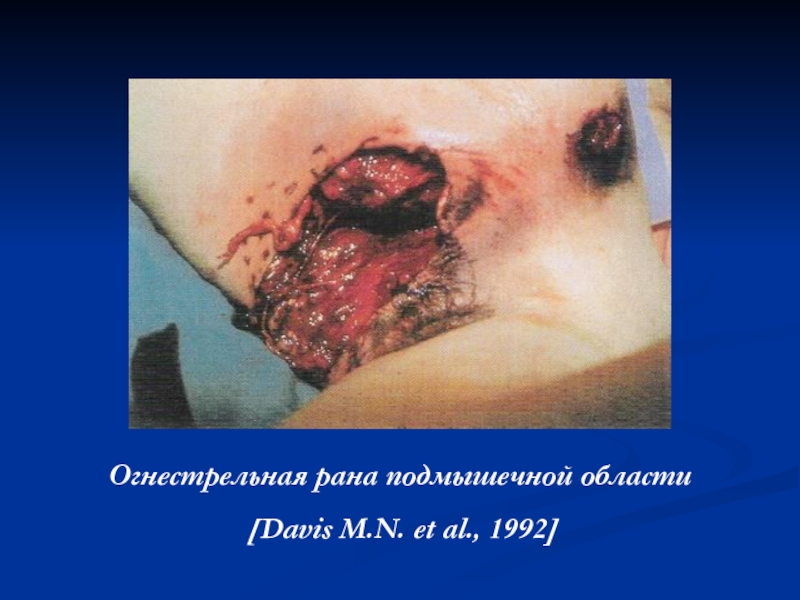 Огнестрельная рана подмышечной области [Davis M.N. et al., 1992]