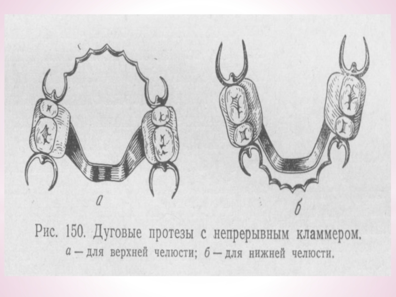 Кламмерная система