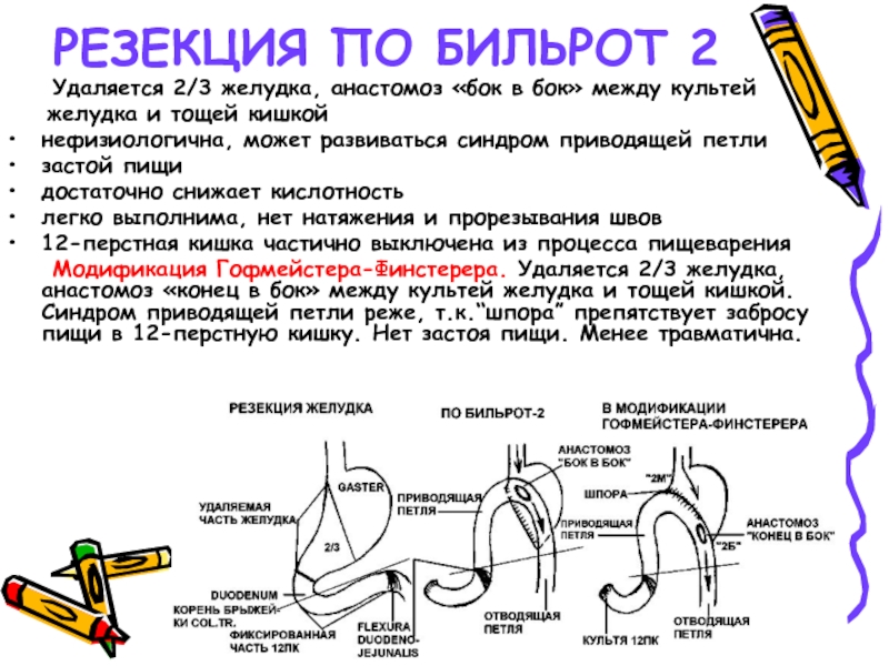 Субтотальная гистерэктомия презентация