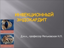 инфекционный эндокардит