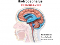 Выполнили:
Воробьёва Е.
Яишенкина О.
ГИДРОЦЕФАЛИЯ