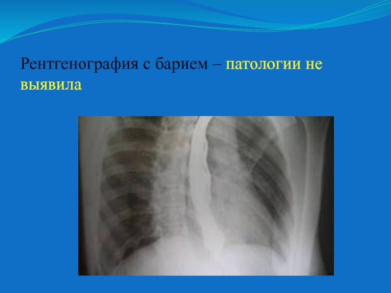 После бария. Рентгеновские снимки с патологиями.