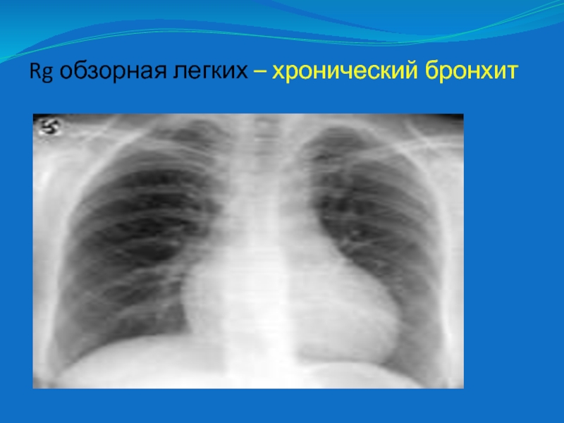 Бронхит на рентгене легких. Хронический бронхит ФЛГ. Бронхит рентген снимок легких. Хронический бронхит рентгенограмма. Хронический бронхит на флюорографии.