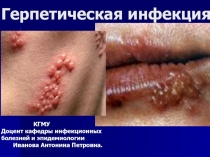 Герпетическая инфекция
КГМУ
Доцент кафедры инфекционных
болезней и