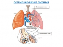 ОСТРЫЕ НАРУШЕНИЯ ДЫХАНИЯ