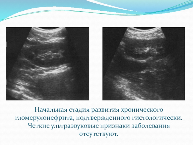 Для ультразвуковой картины почек при остром гломерулонефрите будет характерно