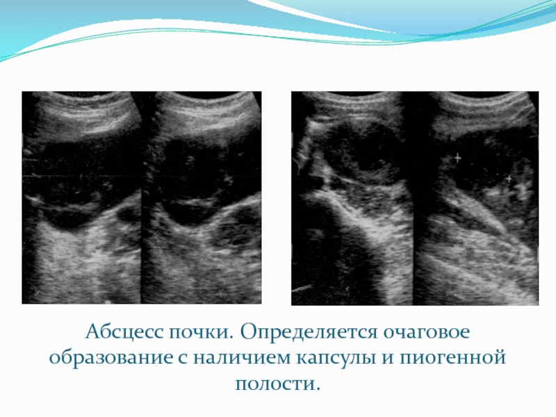 Очаговое образование. Очаговое образование почки. Очаговые образования в почках на УЗИ. Абсцесс почки профилактика.