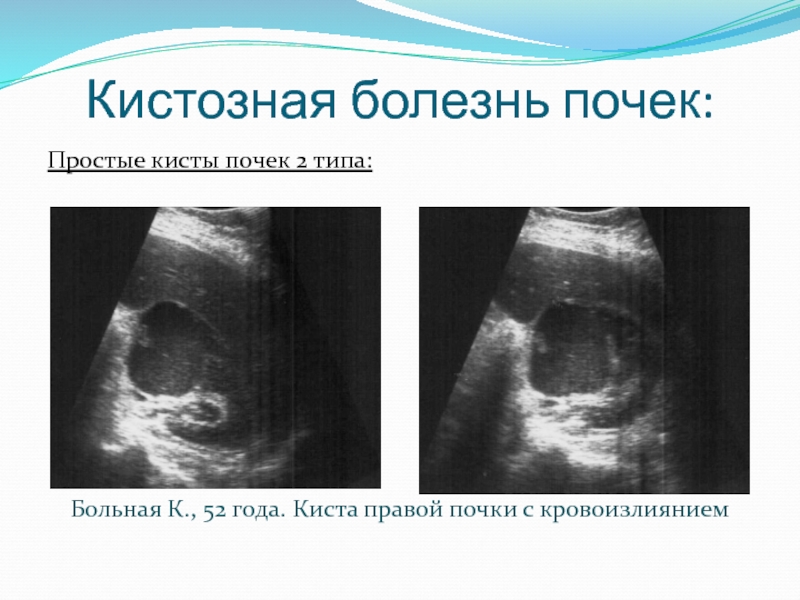 Киста правой почки. Кистозные заболевания почек. Кровоизлияние в кисту почки.