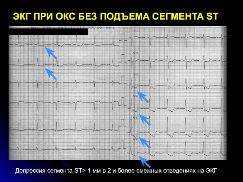 Острым коронарным синдромом без. Инфаркт миокарда с подъемом сегмента ст ЭКГ. Окс без подъема St на пленке ЭКГ. Окс с подъёмом St ЭКГ передняя стенка. Инфаркт миокарда без подъема сегмента St классификация.