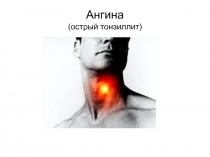 Ангина (острый тонзиллит)