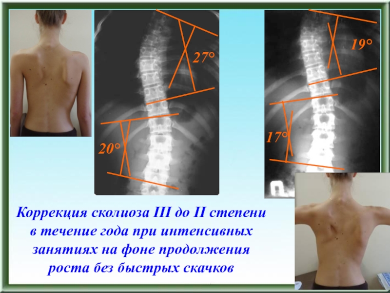 Степени сколиоза по градусам фото