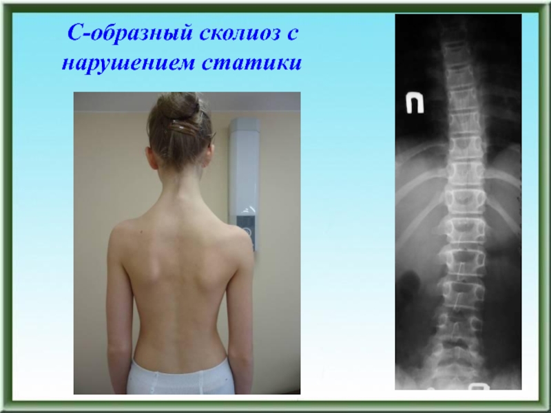 Мр картина нарушения статики шейного отдела позвоночника