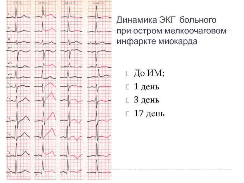 Динамика ЭКГ больного при остром мелкоочаговом инфаркте миокарда До ИМ;1 день3 день17 день