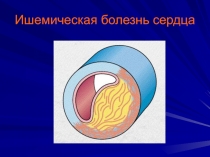 Ишемическая болезнь сердца