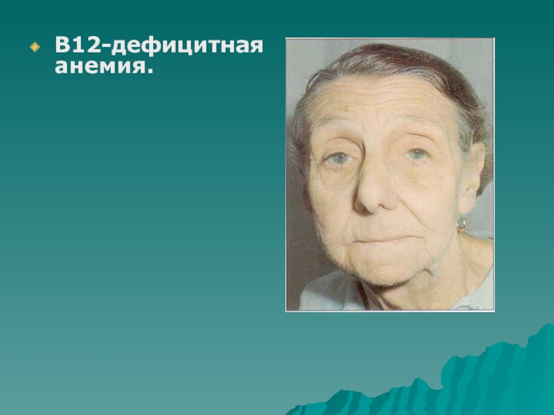 Дефицитная анемия. Клиника б12 дефицитной анемии. B12 анемия клиника. 12.Клиника в12-дефицитной анемии. Кожа при б12 дефицитной анемии.