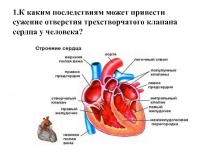 1.К каким последствиям может привести сужение отверстия трехстворчатого клапана