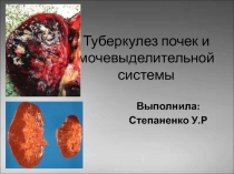 Туберкулез почек и мочевыделительной системы