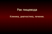 Рак пищевода Клиника, диагностика, лечение