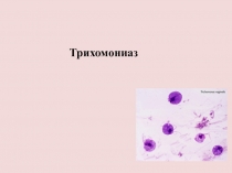 Трихомониаз