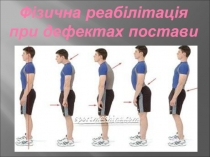 Фізична реабілітація при дефектах постави