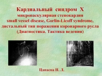 Кардиальный синдром Х
микроваскулярная стенокардия
small vessel disease,