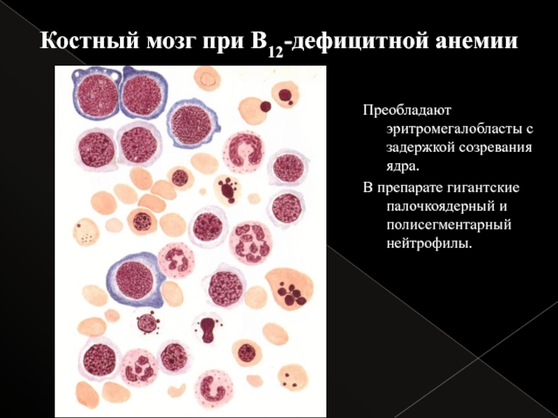 Анемия в12 дефицитная анемия картина крови