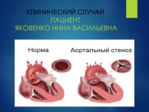 КЛИНИЧЕСКИЙ СЛУЧАЙ ПАЦИЕНТ ЯКОВЕНКО НИНА ВАСИЛЬЕВНА