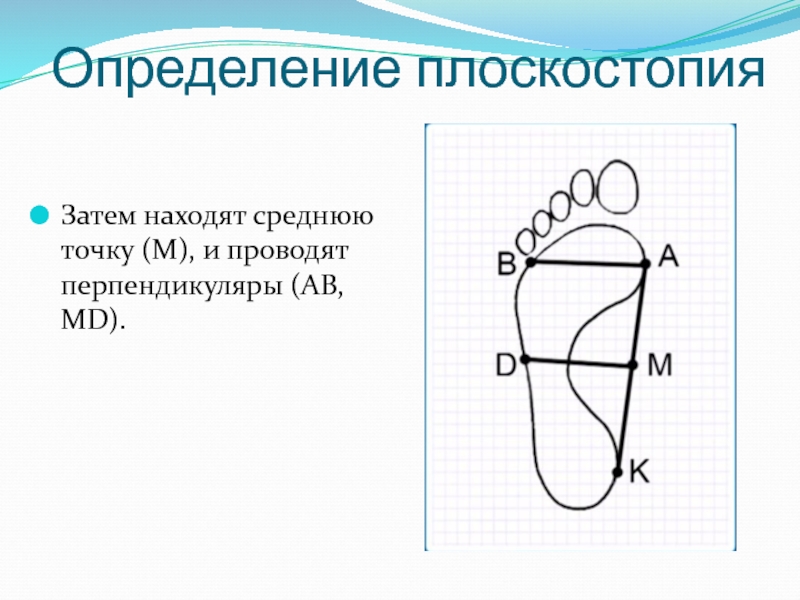 Определение плоскостопия по рисунку