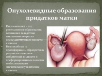 Опухолевидные образования придатков матки